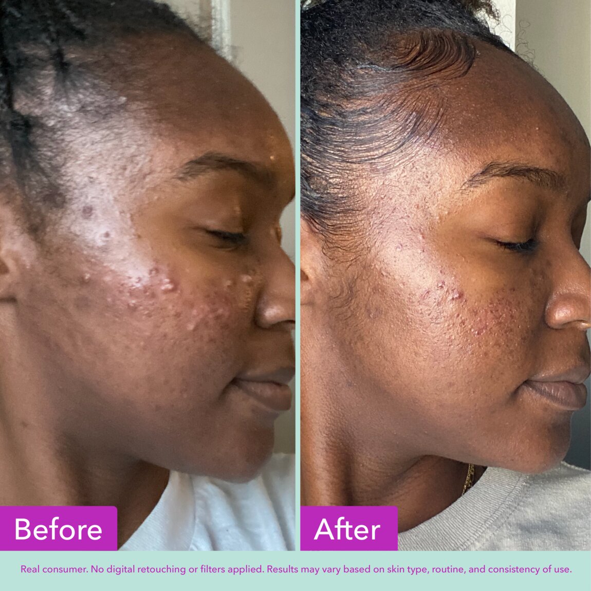 acne-foaming-cleanser-d8 zb_p.jpg